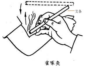 Pecking Moxibustion