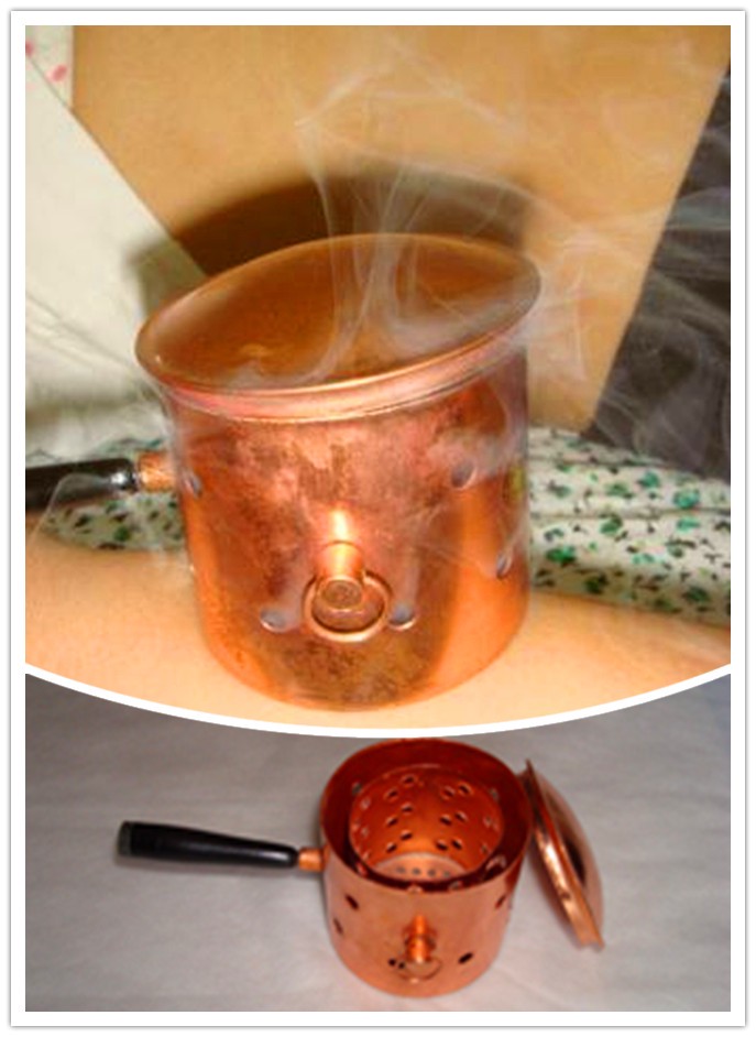 Moxibustion with a Moxa Burner